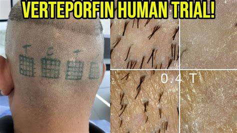 Verteporfin, marketed as Visudyne, is a benzoporphyrin derivative. . Verteporfin scar human trials